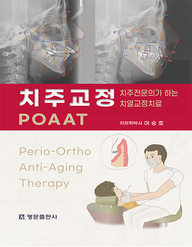 치주교정 POAAT - 치주전문의가 하는 치열교정