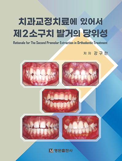 치과교정치료에 있어서 제2소구치 발거의 당위성