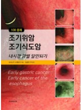 100증례 조기위암 조기식도암 내시경감별 달인되기