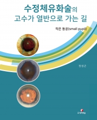 수정체유화술의 고수가 열반으로 가는 길