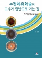 수정체유화술의 고수가 열반으로 가는 길