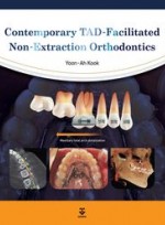 Contemporary TAD-Facilitated Non-Extraction Orthodontics