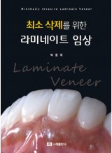 최소 삭제를 위한 라미네이트 임상