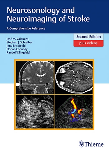 Neurosonology and Neuroimaging of Stroke 2e