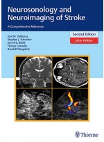Neurosonology and Neuroimaging of Stroke 2e