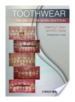 Toothwear: The ABC of the Worn Dentition  