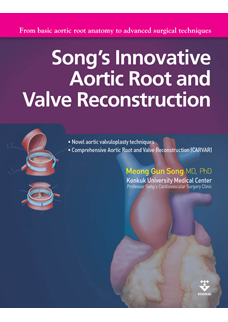 Song's Innovative Aortic Root and Valve Reconstruction