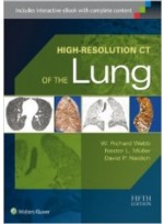 High-Resolution CT of the Lung, 5/e