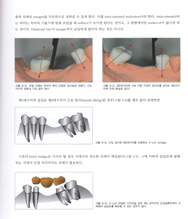 AO브리지-고정성보철물의 최소침습적 접근 