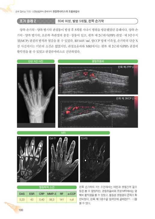 관절류마티스의 초음파검사 - 손에 잡히는 기초스캔방법부터 증례까지   