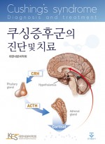 쿠싱증후군의 진단 및 치료