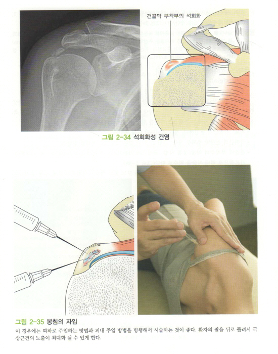 한의사를 위한 통증치료 매뉴얼 Part 1: 총론 상지