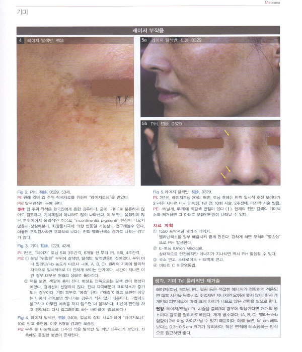안면 색소질환 치료 - 강원형 박사의 레이저를 이용한