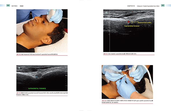 초음파를 이용한 통증치료- 그림과 사진으로 배우는 168가지 주사테크닉