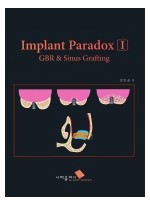 Implant Paradox I GBR & Sinus Grafting