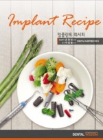 임플란트 레시피 (Implant Recipe)