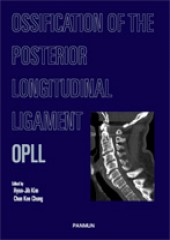 OPLL: Ossification of the Posterior Longitudinal Ligament