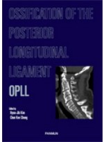 OPLL: Ossification of the Posterior Longitudinal Ligament