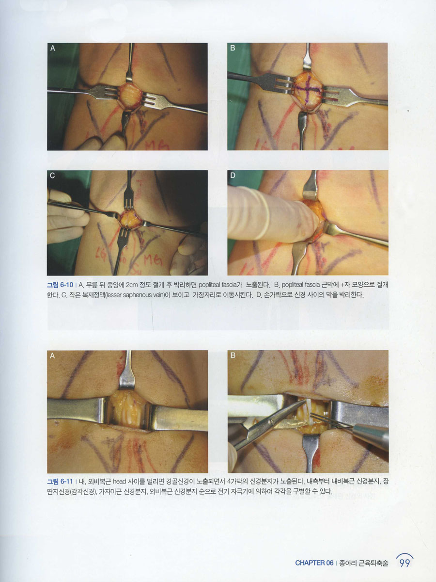 종아리 성형술