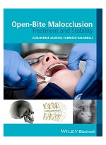 Open-Bite Malocclusion: Treatment and Stability  