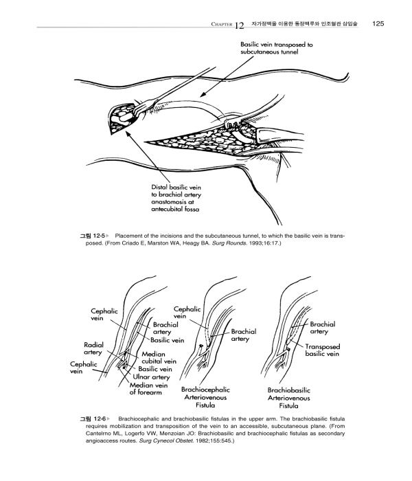 혈관접근‐혈액투석을 위한 혈관수술 (Vascular Access – Principles and Practice) 