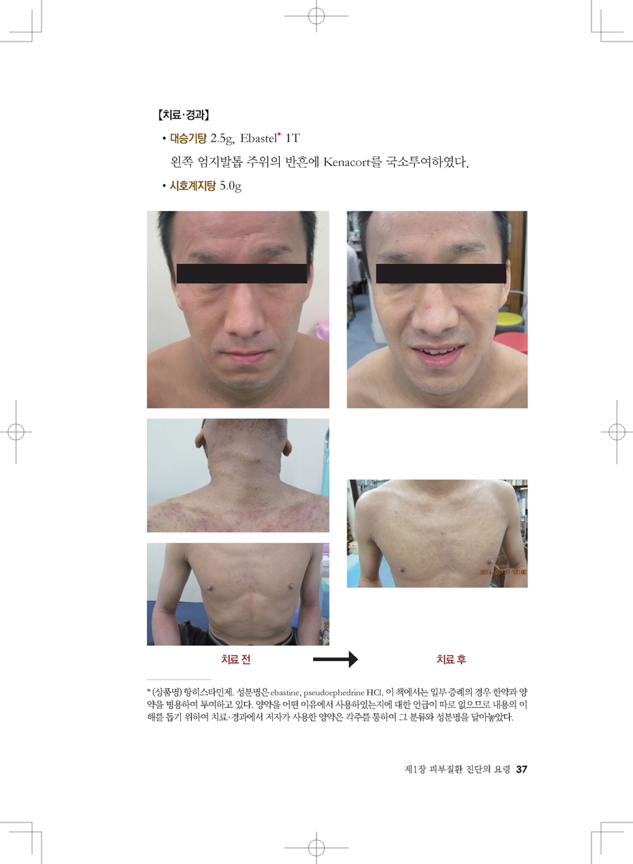 피부질환의 한의학치료 57증례