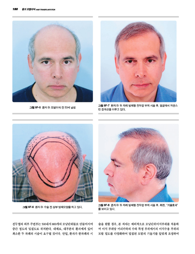  Unger's 모발이식 Hair Transplantation (DVD포함)