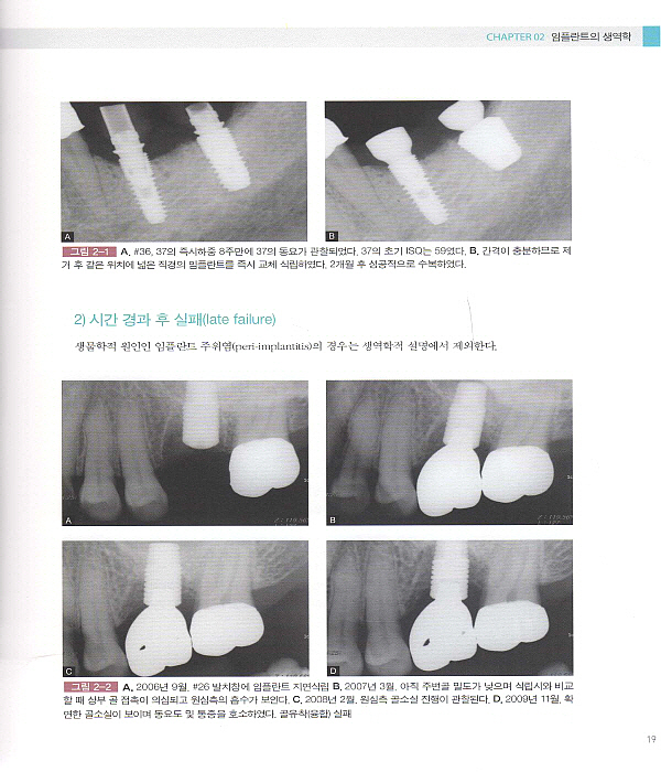 임플란트의 요점 vol.1