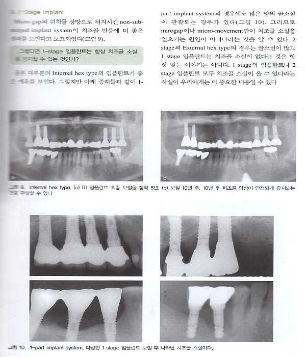 PERI-IMPLANT DISEASE & GBR