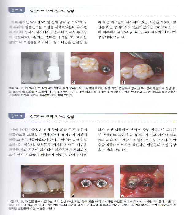 PERI-IMPLANT DISEASE & GBR