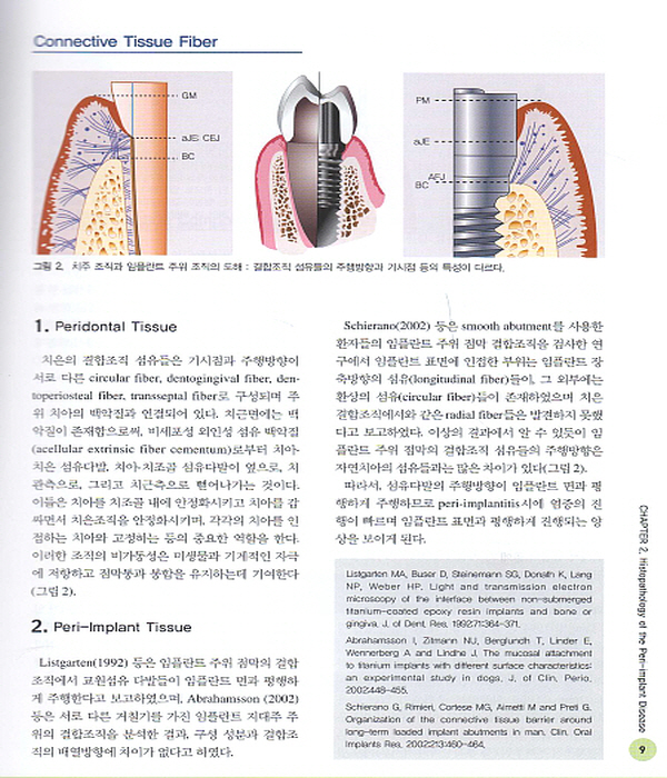 PERI-IMPLANT DISEASE & GBR