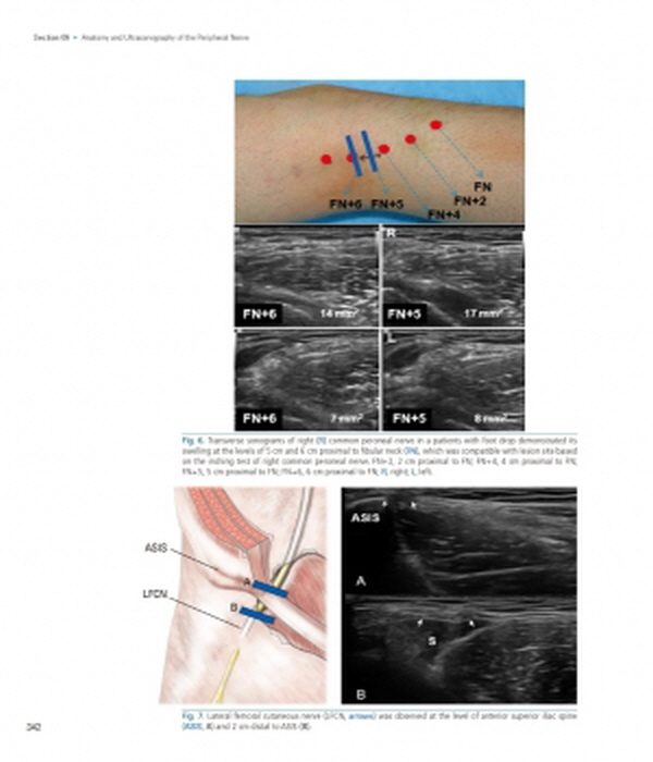 신경근골격 초음파(Neuromusculoskeletal Ultrasonography)