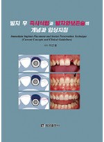 발치 후 즉시식립과 발치와보존술의 개념과 임상지침  