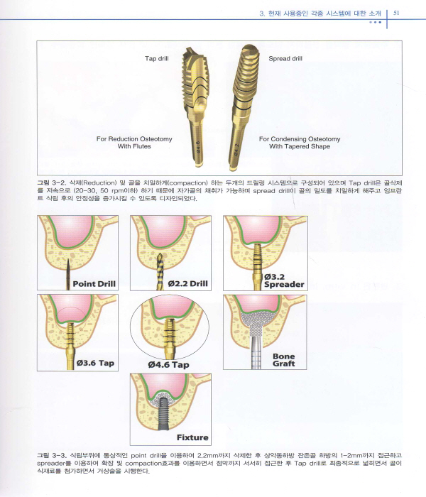 치조정접근법을 통한 상악동 골이식술