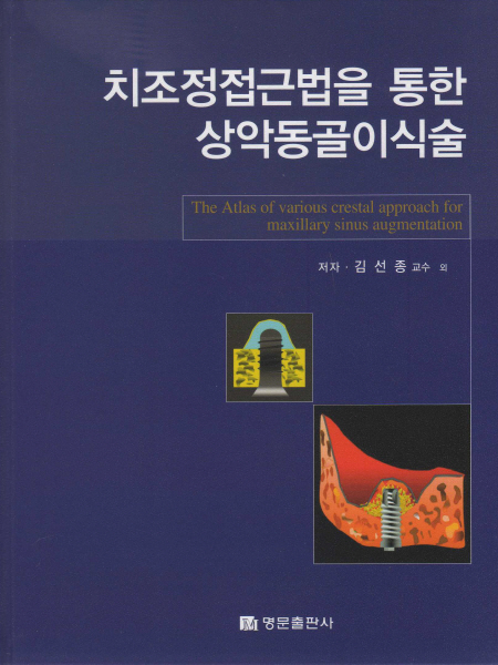 치조정접근법을 통한 상악동 골이식술