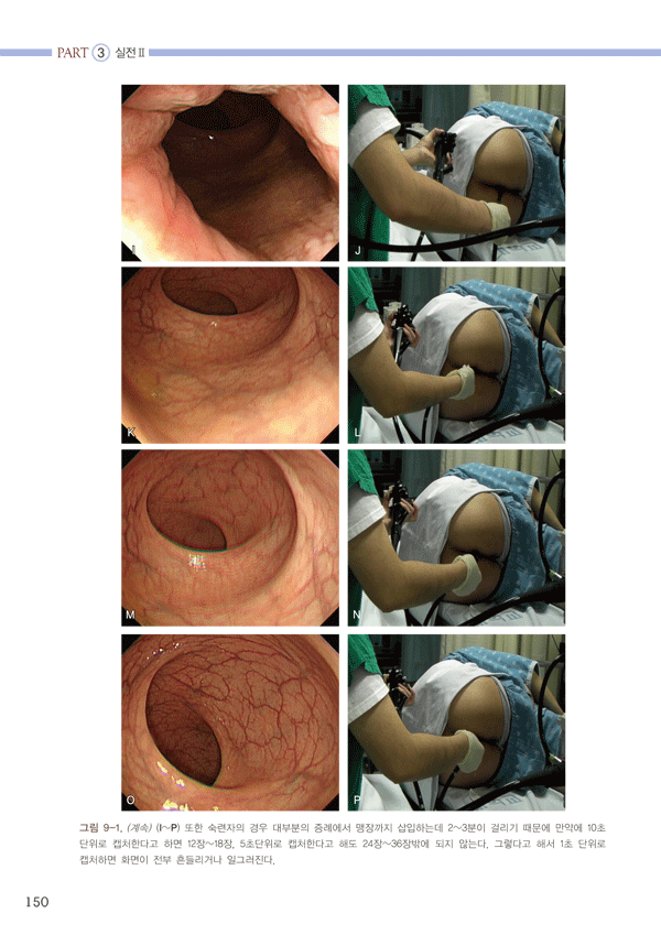 대장내시경 삽입법 - 일차진료의를 위한