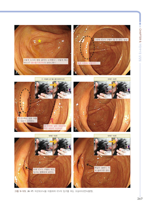 대장내시경 삽입법 - 일차진료의를 위한