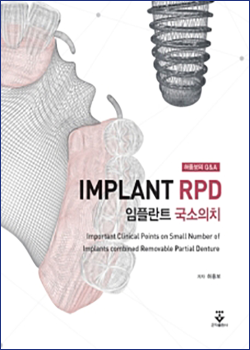 허중보의 Q&A 임플란트 국소의치 (Implant RPD)