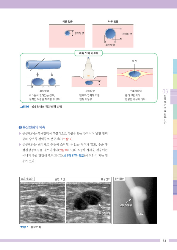 하지정맥류 혈관내 레이저 치료   