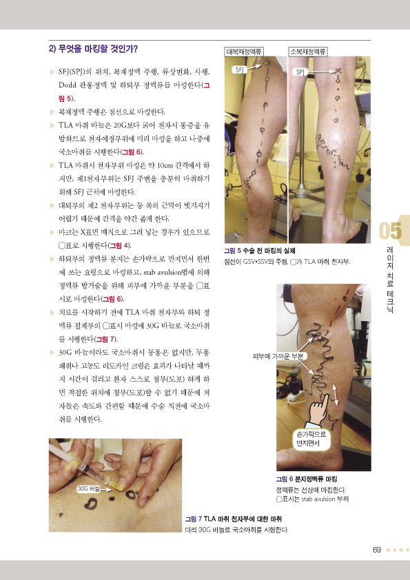 하지정맥류 혈관내 소작술 레이저 및 고주파 치료 제2판