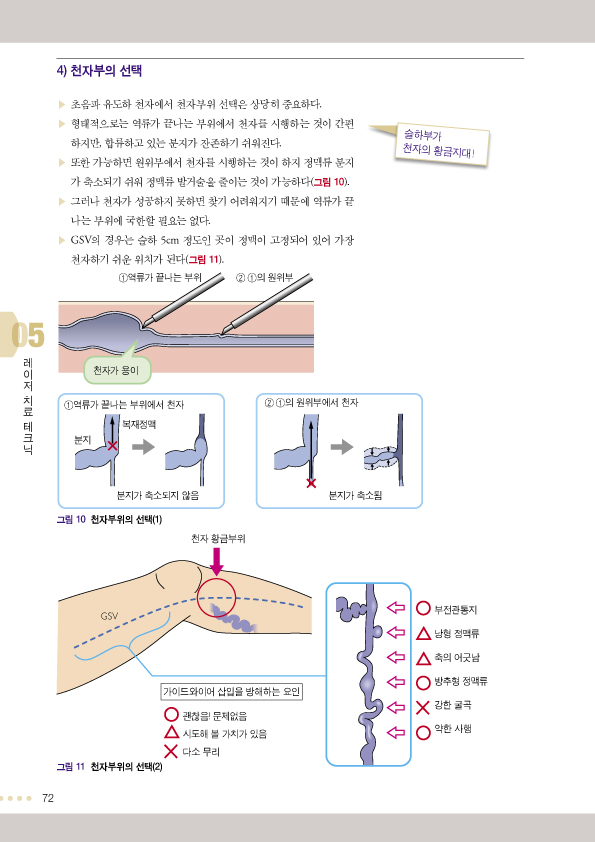 하지정맥류 혈관내 소작술 레이저 및 고주파 치료 제2판