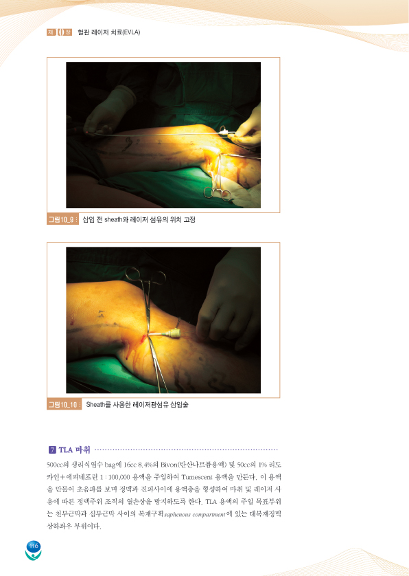 손에 잡히는 하지정맥류DVD 혈관레이저치료   