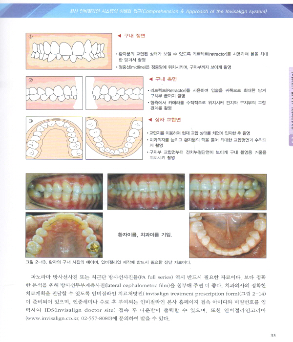 최신 인비절라인 시스템의 이해와 접근