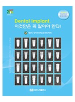 (Implant 임상지침서) Dental Implant 이것만은 꼭 알아야 한다! 