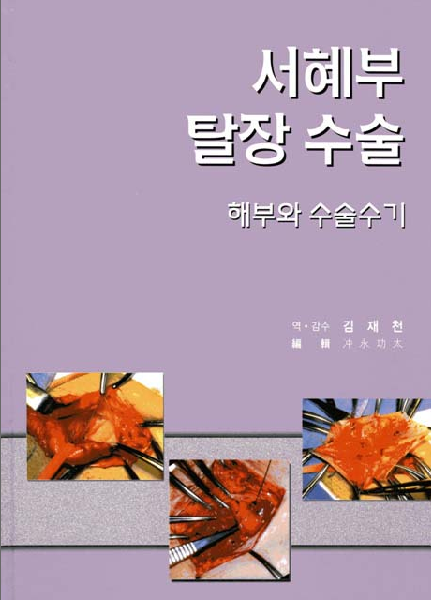 서혜부 탈장 수술