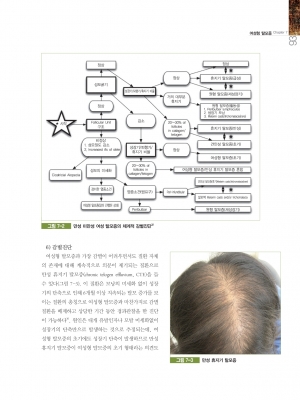 모발이식 (Hair Transplantation) 