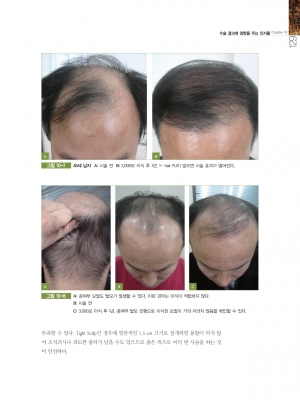 모발이식 (Hair Transplantation) 