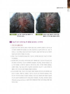 모발이식 (Hair Transplantation) 