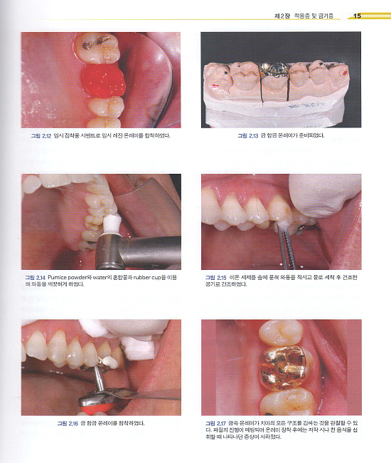  Inlay & Onlay 2nd Edition  