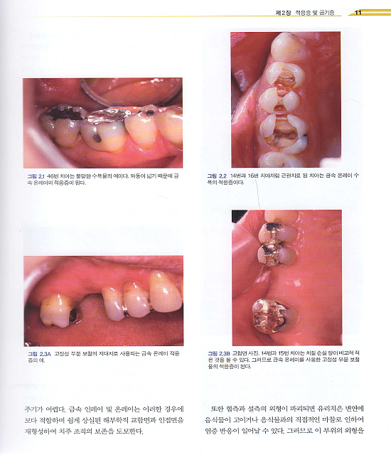  Inlay & Onlay 2nd Edition  